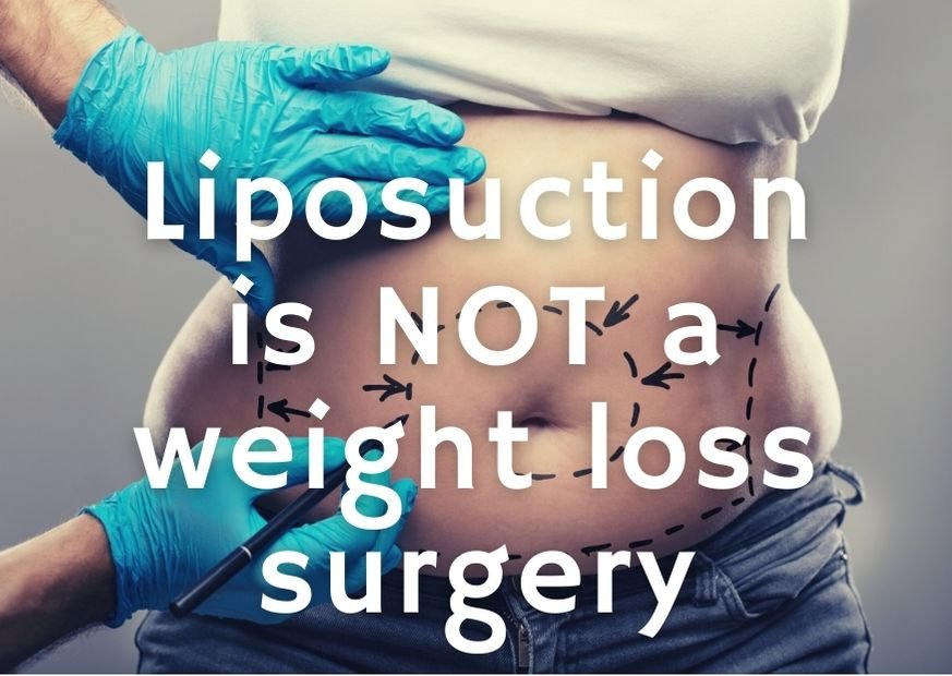 Liposuction is NOT a weight loss surgery